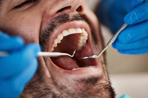 Best Emergency Dentist for Lost Fillings or Crowns in Shelbyville, TN